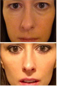 New Jersey Blepharoplasty Testimonial Photo - Jeffrey Schiller, MD